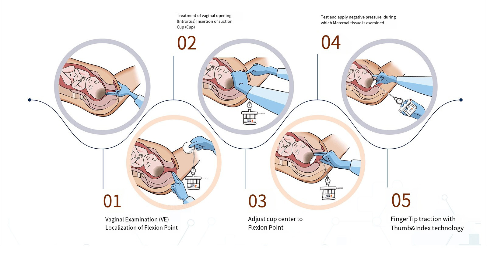 Disposable Fetal Head Suction Device插图